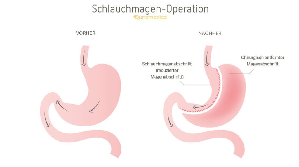 Nutzen und Risiken des Schlauchmagens: Ein Magenverkleinerung in der Türkei, wie die Schlauchmagen-Op, hilft jedes Jahr vielen Menschen...