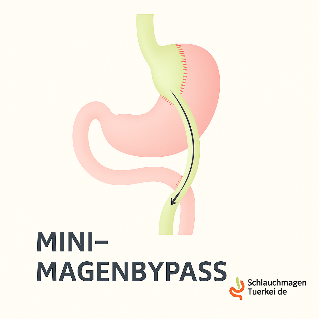 Mini-Magenbypass Türkei Kosten OP in Antalya